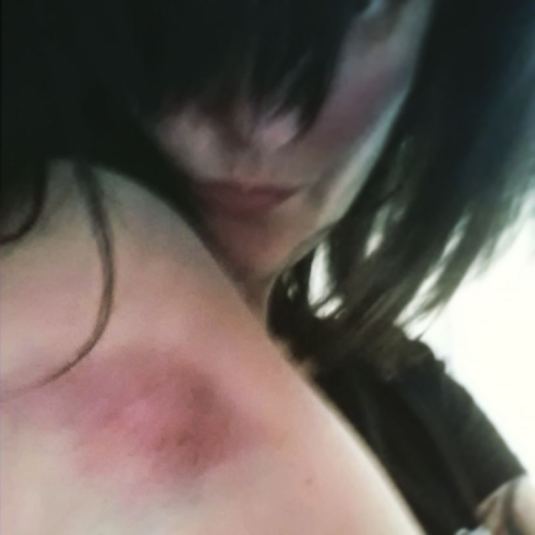 Meredith'sHockey Bruise